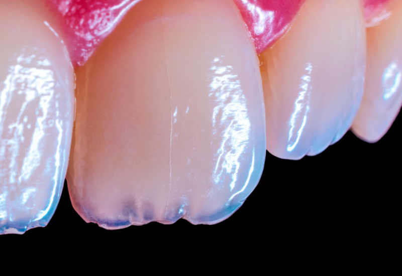 Proces ugradnje zubnih implantata